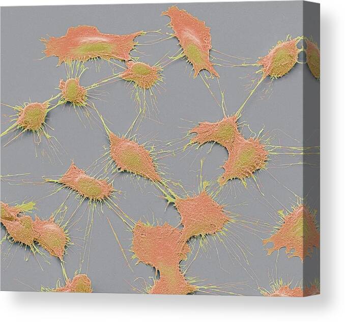 Abnormal Canvas Print featuring the photograph Prostate Cancer Cells by Steve Gschmeissner