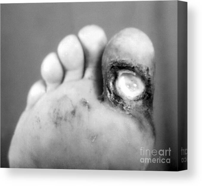 Bacterial Canvas Print featuring the photograph Syphilis Ulcer by Science Source