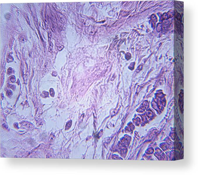 Purple Canvas Print featuring the photograph Microscopic Image of Breast Carcinoma #1 by Duncan Smith