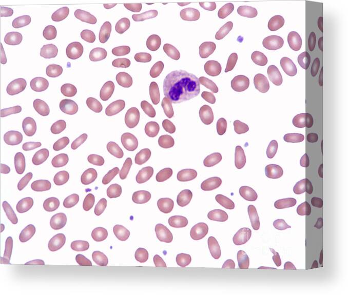 Erythrocyte Canvas Print featuring the photograph Ovalocytosis Lm by Garry DeLong