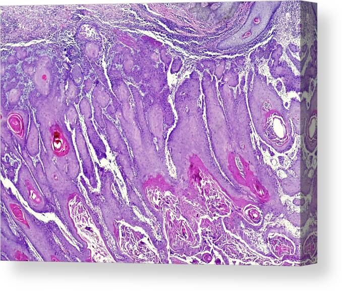 Anatomy Anatomical Canvas Print featuring the photograph Cutaneous Squamous Cell Carcinoma by Nigel Downer/science Photo Library