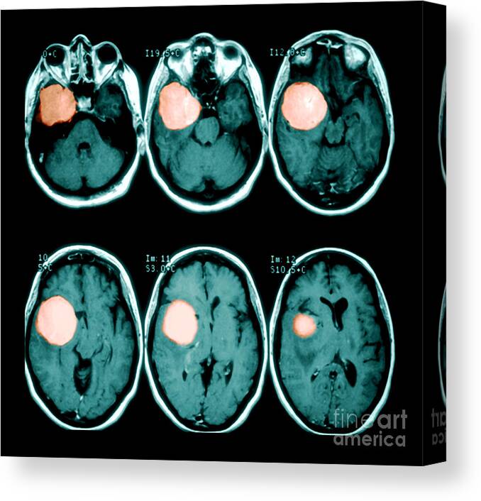 Mri Canvas Print featuring the photograph Brain Tumor by Medical Body Scans