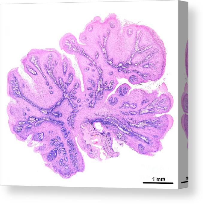 Microscopy Canvas Print featuring the photograph Soft Palate Papilloma #4 by Jose Calvo/science Photo Library