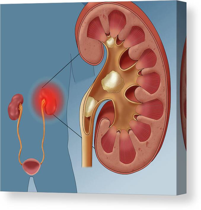 Abnormal Canvas Print featuring the photograph Kidney Stone Pain, Illustration by Monica Schroeder