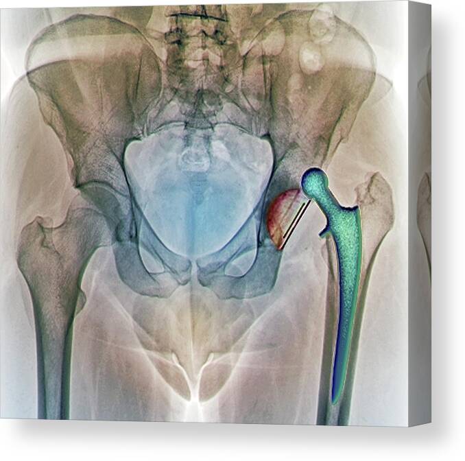 Artificial Canvas Print featuring the photograph Dislocated Hip Replacement, X-ray by Zephyr