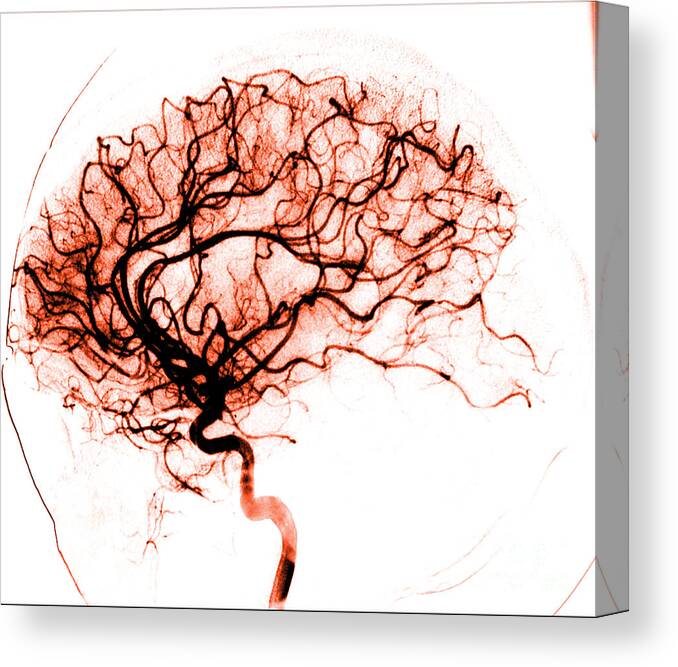 Catheter Cerebral Angiogram Canvas Print featuring the photograph Cerebral Angiogram by Medical Body Scans