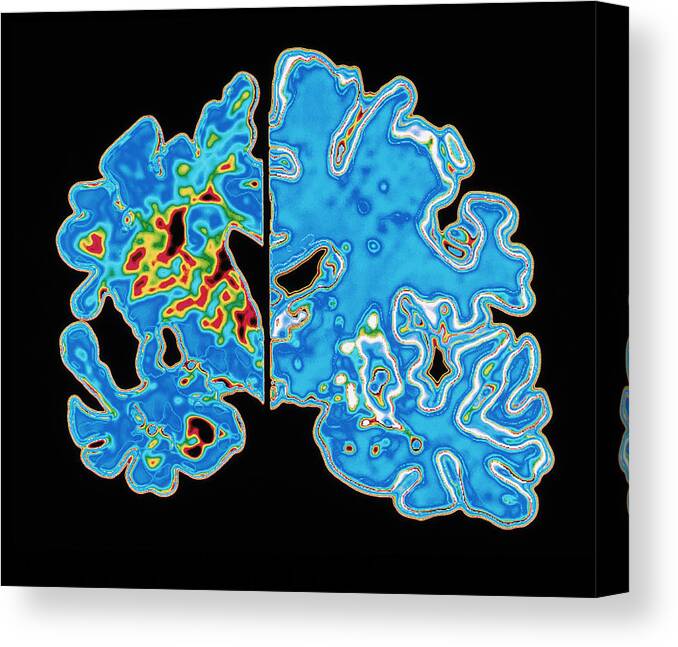Alzheimer's Disease Canvas Print featuring the photograph Sectioned Brains: Alzheimer's Disease Vs Normal by Pasieka