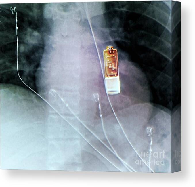 Female Canvas Print featuring the photograph Cardiac Monitor Implant #1 by Zephyr/science Photo Library
