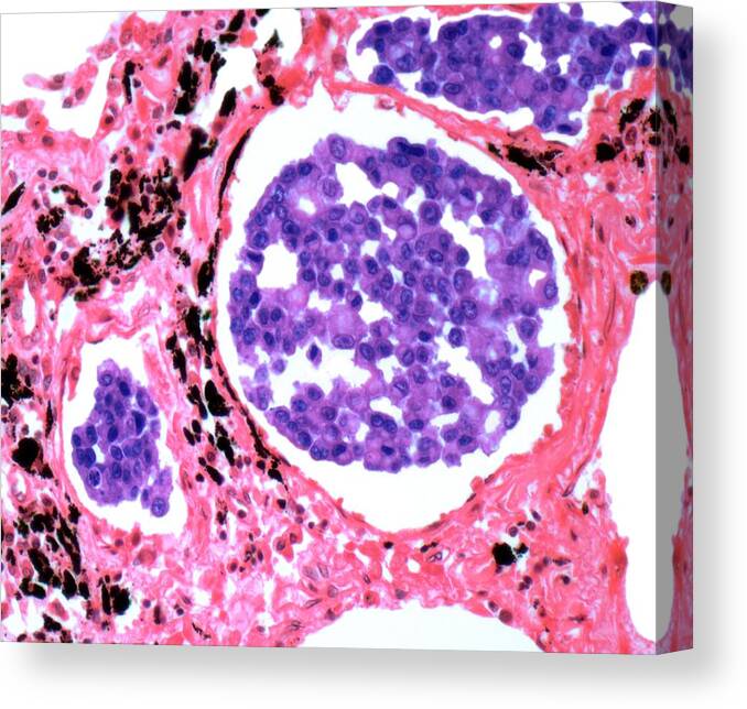Metastasis Canvas Print featuring the digital art Secondary Lung Cancer, Light Micrograph by Steve Gschmeissner