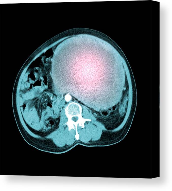 Disease Canvas Print featuring the photograph Abdominal Sarcoma #1 by Du Cane Medical Imaging Ltd/science Photo Library