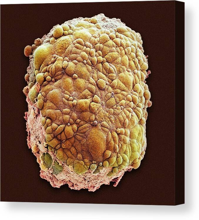 Abnormal Canvas Print featuring the photograph Mesothelioma Spheroid #1 by National Cancer Institute/science Photo Library