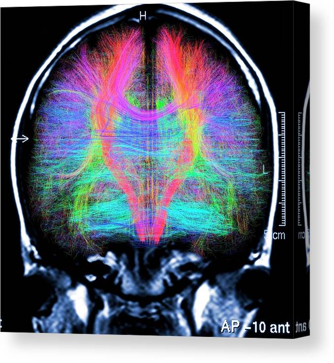 Brain Scan Canvas Print featuring the photograph Brain Mri And White Matter Fibres by Alfred Pasieka/science Photo Library