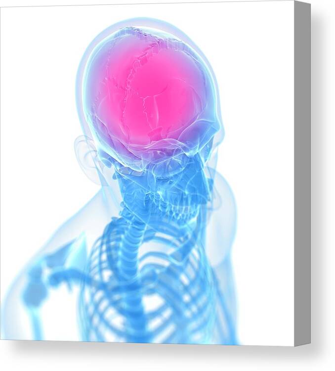 Anatomy Canvas Print featuring the photograph Headache #62 by Sciepro/science Photo Library