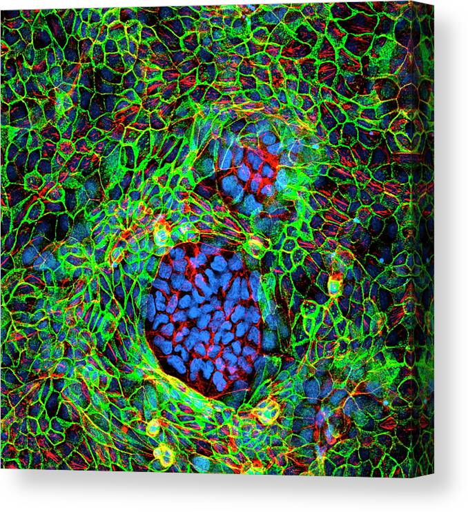 Tumour Canvas Print featuring the photograph Cancer Cells by 