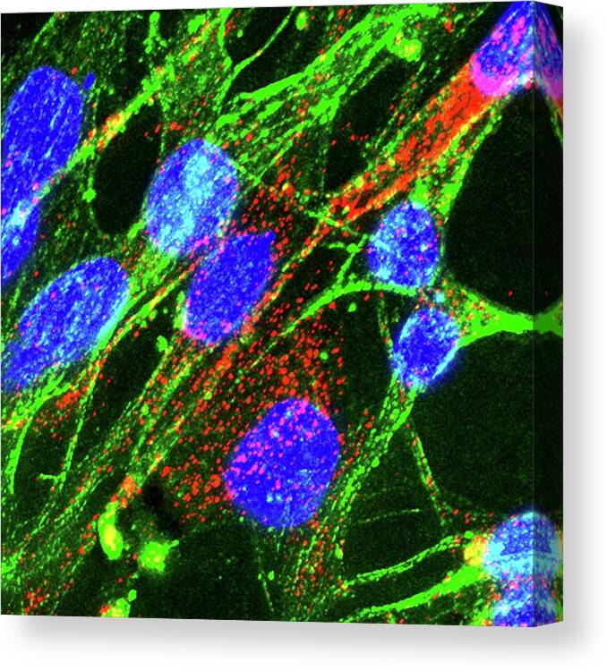 Alpha-synuclein Canvas Print featuring the photograph Glioblastoma Cells by R. Bick, B. Poindexter, Ut Medical School/science Photo Library