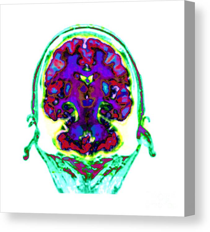 Spect Canvas Print featuring the photograph Spect Exam Of Human Brain by Living Art Enterprises