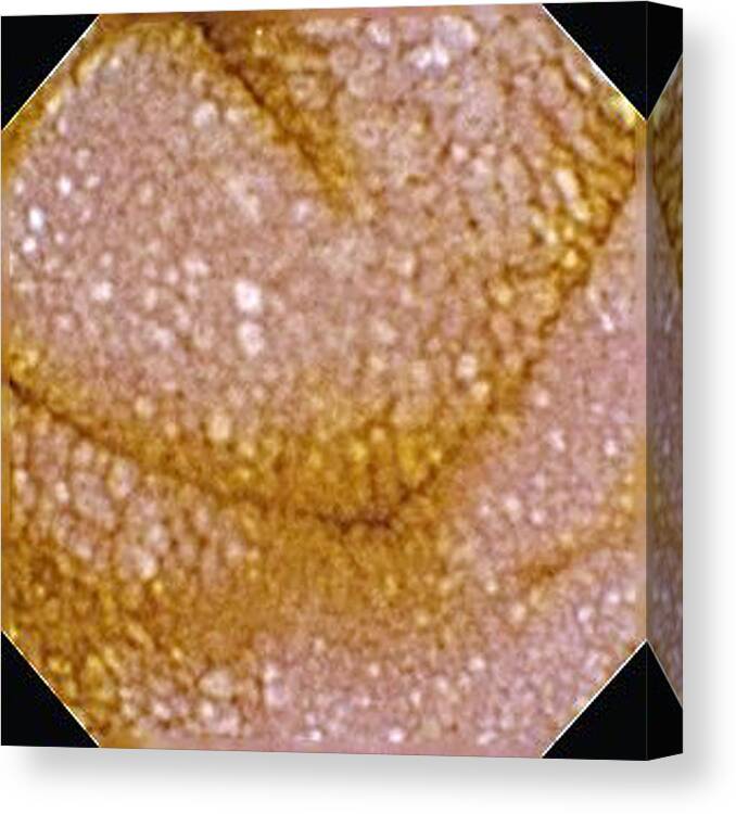 Whipple's Disease Canvas Print featuring the photograph Whipple's Disease by Gastrolab