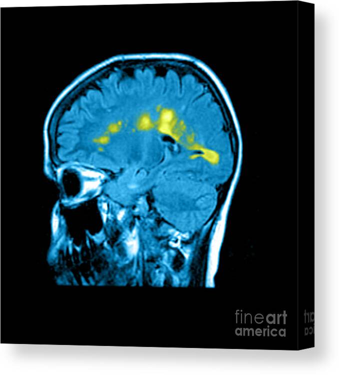 Abnormal White Matter Canvas Print featuring the photograph Mri Of Multiple Sclerosis #6 by Medical Body Scans