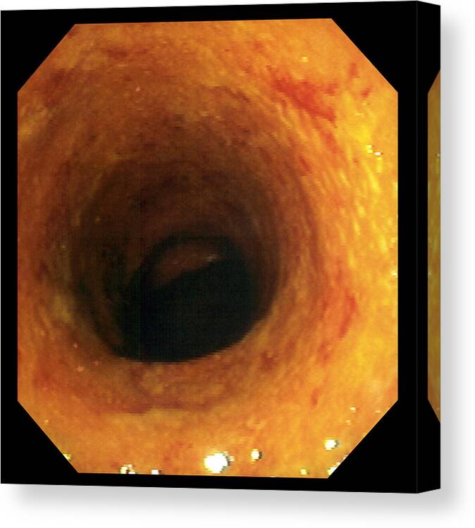 Ulcerative Colitis Canvas Print featuring the photograph Ulcerative Colitis by David M. Martin, Md