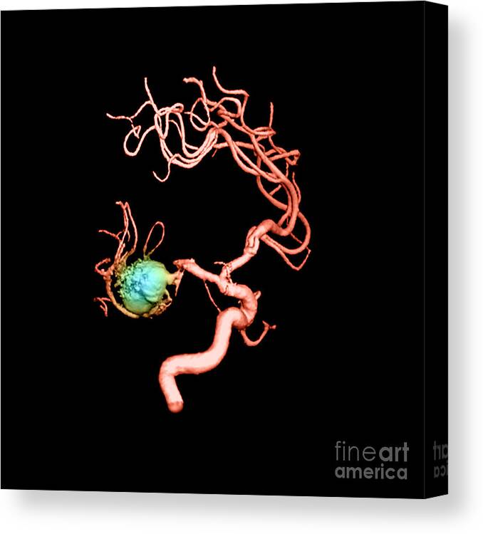 3-d Imagery Canvas Print featuring the photograph Aneurysm In The Human Brain #3 by Medical Body Scans