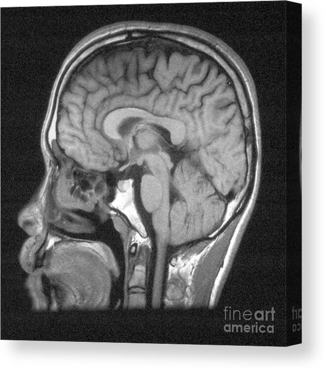 Mri Canvas Print featuring the photograph Normal Brain Structures In Head, Mri by Scott Camazine