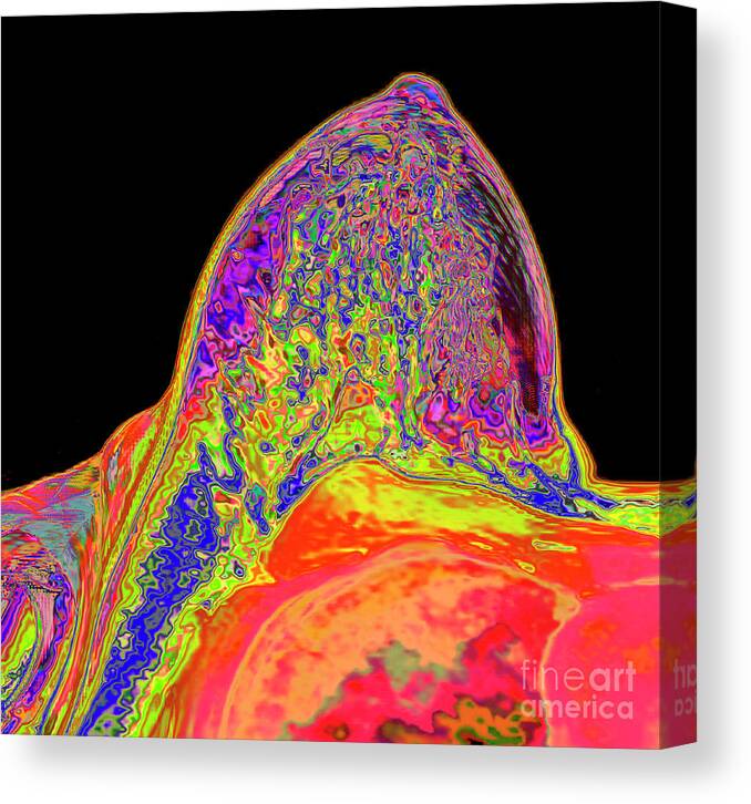 Fibrocystic Breast Disease #1 Canvas Print / Canvas Art by K H Fung/science  Photo Library - Pixels Canvas Prints