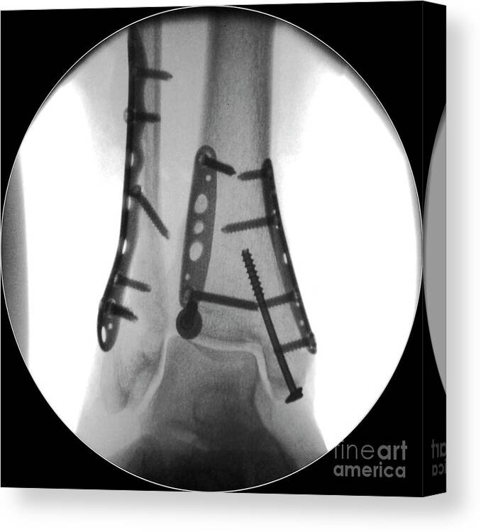Injury Canvas Print featuring the photograph Pinned Fractured Ankle Bones by Science Photo Library