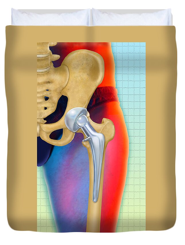 Art Duvet Cover featuring the photograph Prosthetic Hip Replacement #1 by Chris Bjornberg