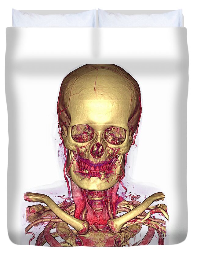 Angiography Duvet Cover featuring the photograph Male Skull & Arterial System #4 by Scott Camazine