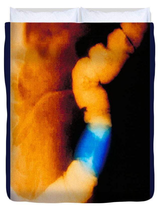 Enhanced Duvet Cover featuring the photograph Abdomen X-ray Of Colon Cancer by Scott Camazine & Sue Trainor