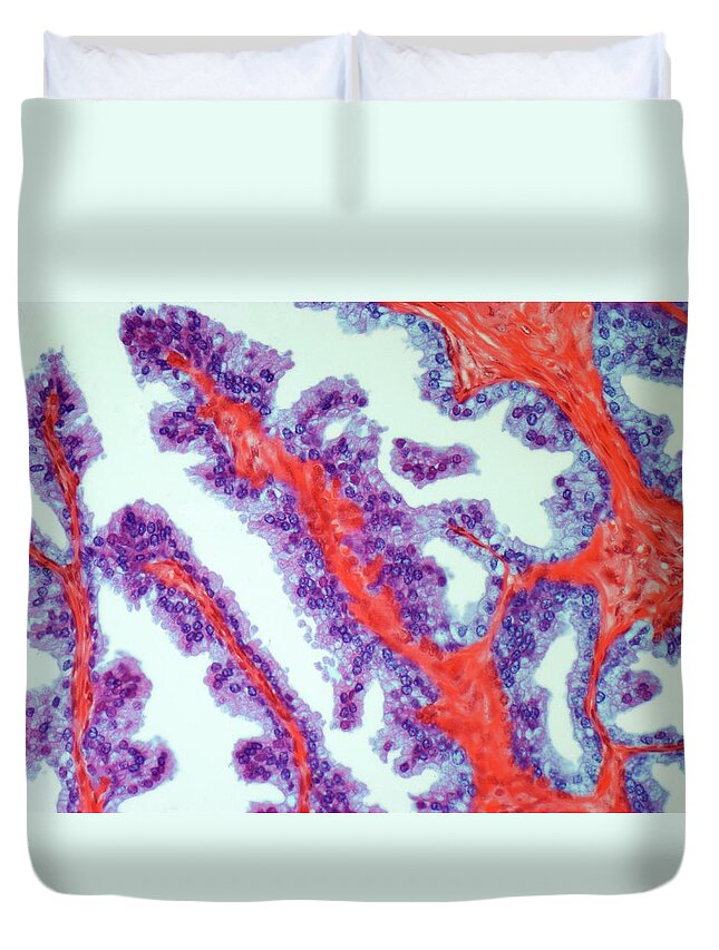 Anatomy Duvet Cover featuring the digital art Prostate Cancer, Light Micrograph by Steve Gschmeissner