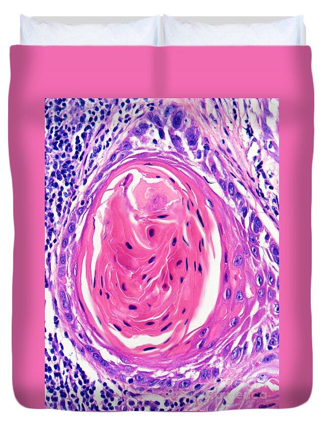 Light Micrograph Duvet Cover featuring the photograph Squamous Cell Carcinoma, Keratin Pearl by Garry DeLong