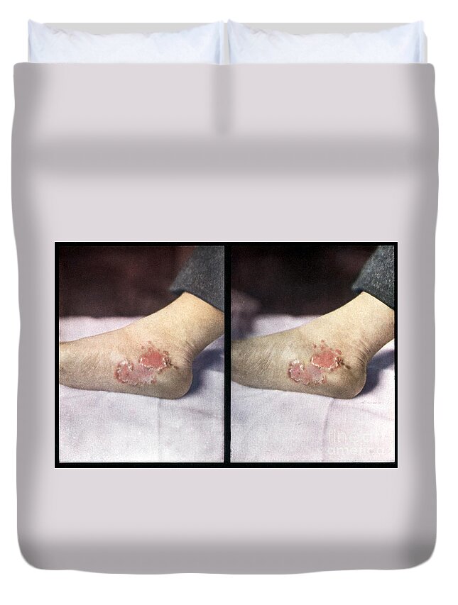 Science Duvet Cover featuring the photograph Tertiary Syphilis, Vintage Stereoscopic by DoubleVision