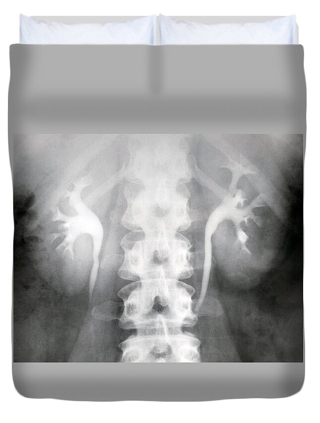 X-ray Duvet Cover featuring the photograph X-ray Of Spinal Cord And Normal Kidneys by AFIP/Science Source