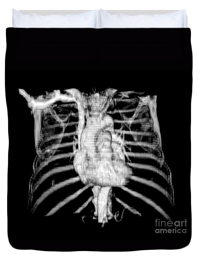 Ct Of Chest Duvet Cover featuring the photograph 3d Ct Reconstruction Of Heart #1 by Medical Body Scans
