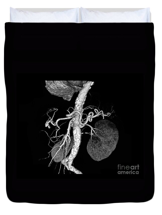 Medical Duvet Cover featuring the photograph Abdominal Aorta #2 by Medical Body Scans