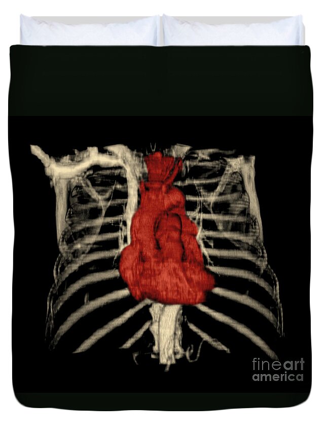 Ct Of Chest Duvet Cover featuring the photograph 3d Ct Reconstruction Of Heart by Medical Body Scans