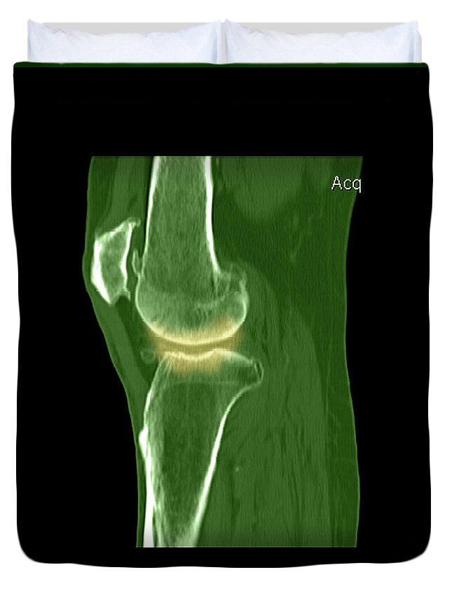 Joint Duvet Cover featuring the photograph Knee Showing Osteoporosis #3 by Medical Body Scans