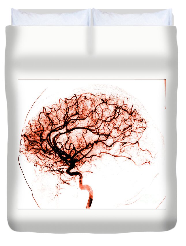 Catheter Cerebral Angiogram Duvet Cover featuring the photograph Cerebral Angiogram by Medical Body Scans