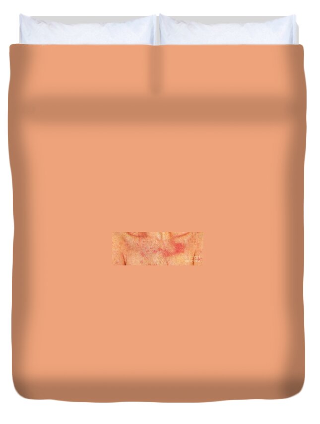 Psoriasis Chest Duvet Cover featuring the photograph Acute Psoriasis by Science Source