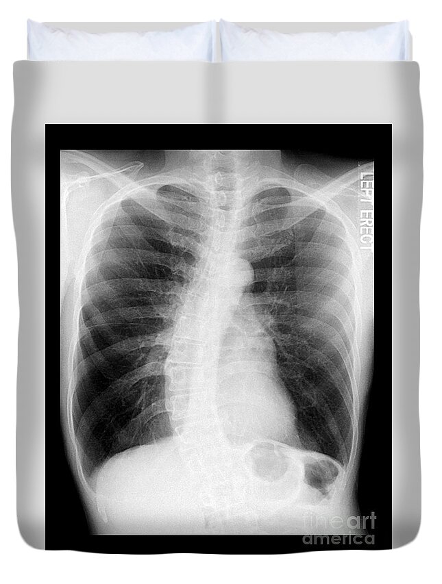 Chest Xray Duvet Cover featuring the photograph Chest X-ray - Copd And Scoliosis by Medical Body Scans