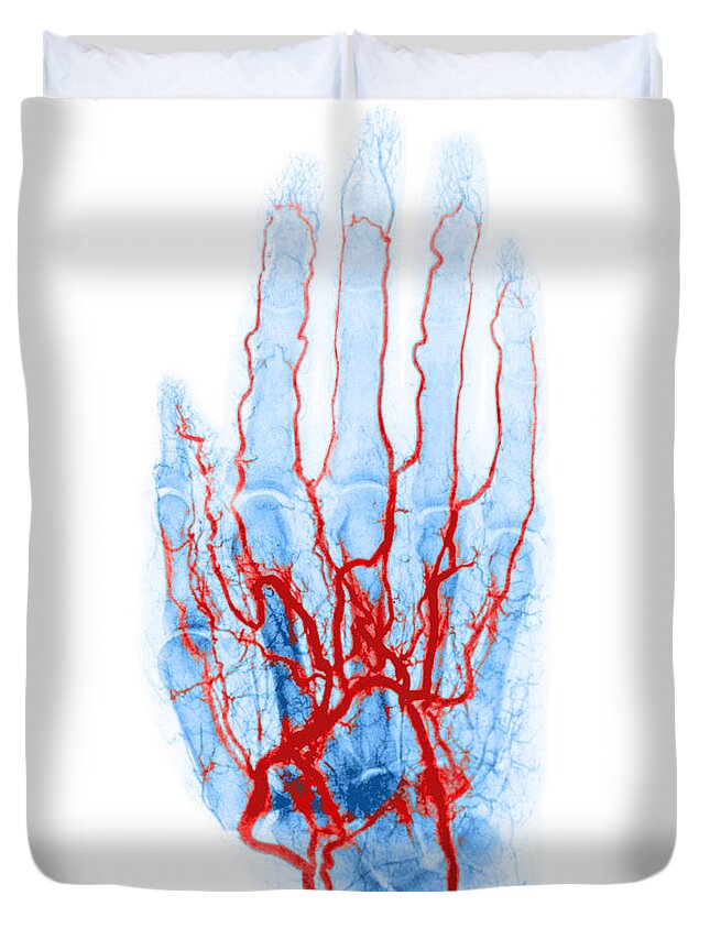 Angiogram Duvet Cover featuring the photograph Hand Arteriogram by Science Source