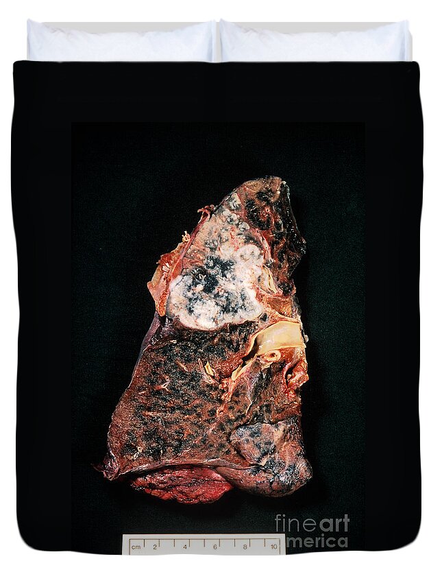 Cancer Duvet Cover featuring the photograph Lung Cancer by Science Source