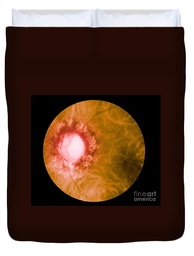 Bacteria Duvet Cover featuring the photograph Retina Infected By Syphilis by Science Source