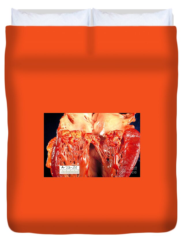 Heart Duvet Cover featuring the photograph Subacute Bacterial Endocarditis by Science Source