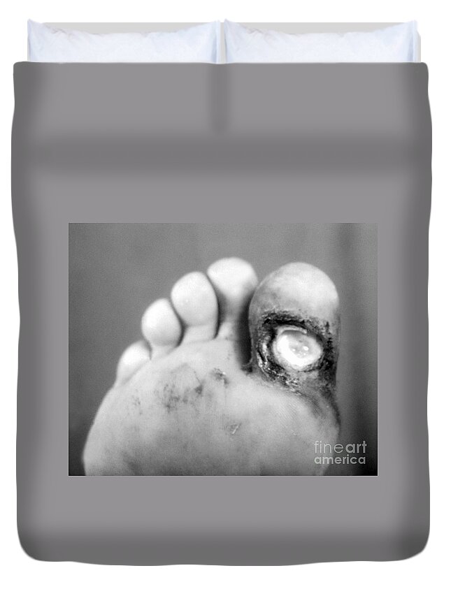 Bacterial Duvet Cover featuring the photograph Syphilis Ulcer by Science Source