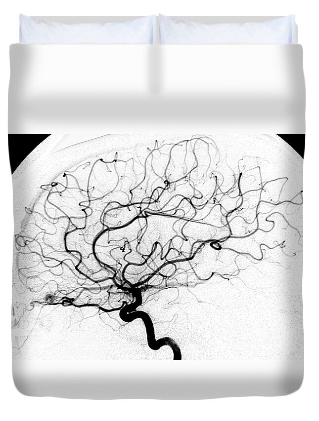 Cerebral Angiogram Duvet Cover featuring the photograph Dural Arterial Venous Fistula, Angiogram by Living Art Enterprises