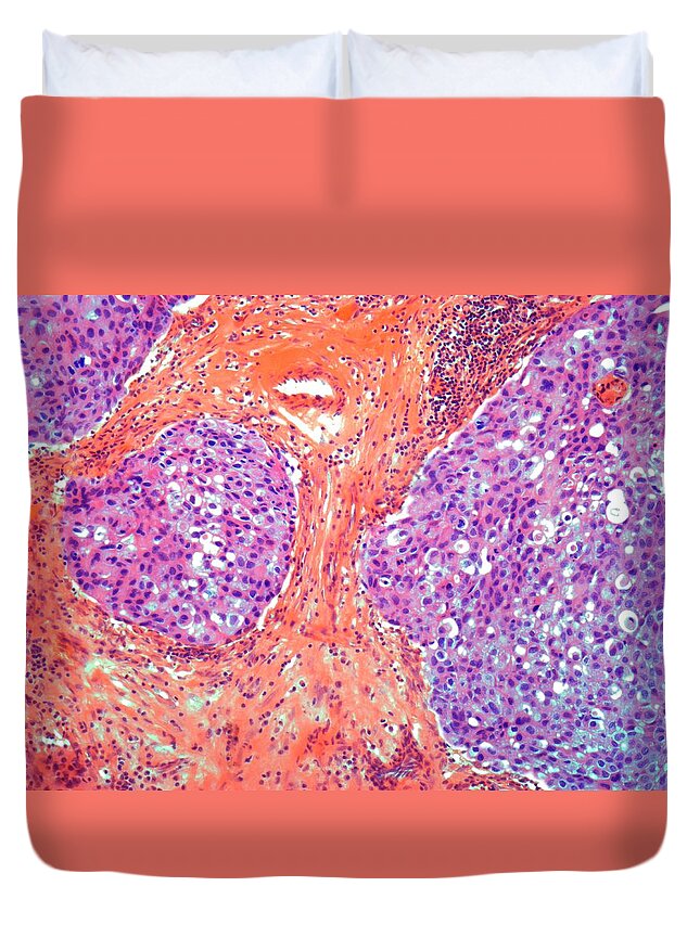 Anatomy Duvet Cover featuring the digital art Breast Cancer, Light Micrograph #1 by Steve Gschmeissner