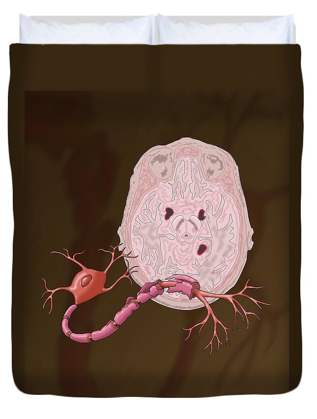 Anatomy Duvet Cover featuring the photograph Multiple Sclerosis #1 by Monica Schroeder