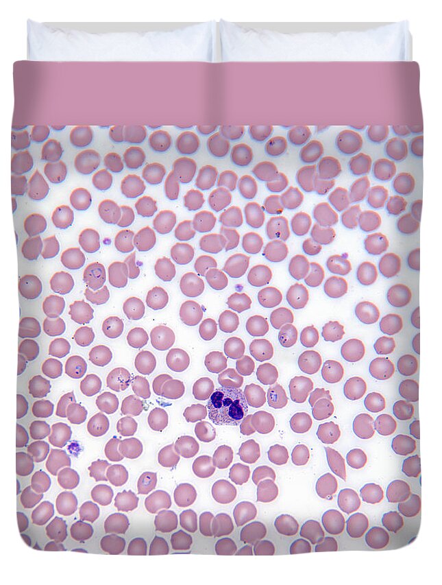 White Background Duvet Cover featuring the photograph Malarial Blood Cells by michael J. Klein, M.d.